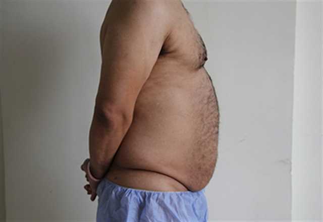 Liposuction