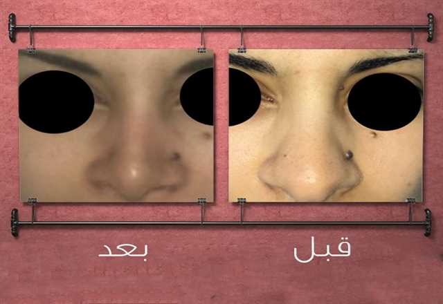 قصة جديدة لتجميل الأنف
