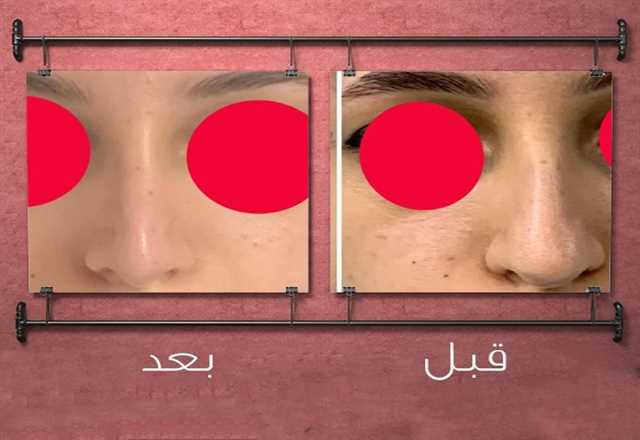 نتائج رائعة لعملية تجميل الأنف