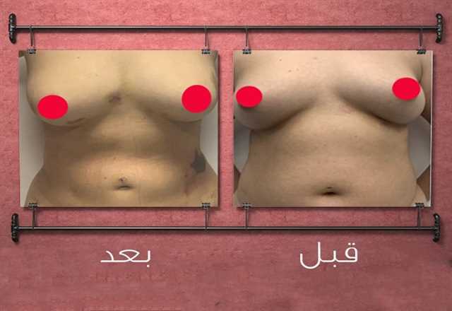 نتائج تكبير و رفع الثدى