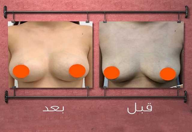 تكبير الثدى لأنوثة أكثر