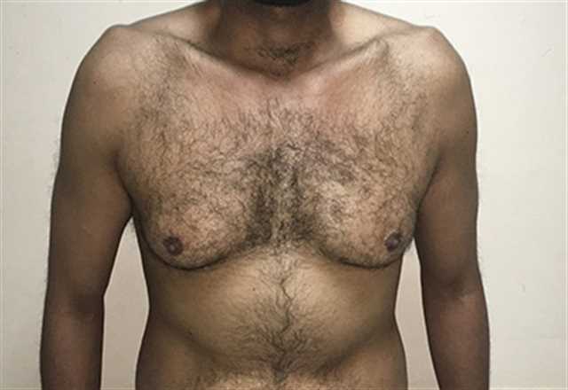 Treating Gynecomastia