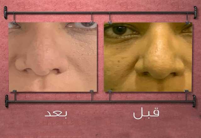 قصة نجاح عملية تجميل الأنف