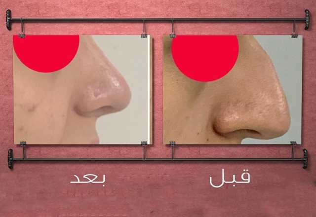 إستعادت ثقتها بنفسها مع عملية تجميل الأنف