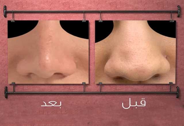 حياة أجمل مع عملية تجميل الأنف