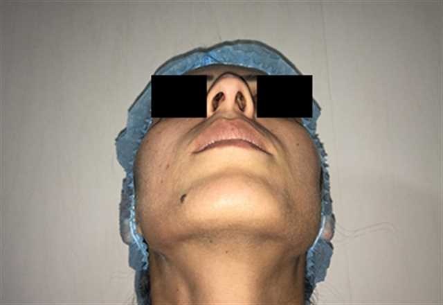 Rhinoplasty