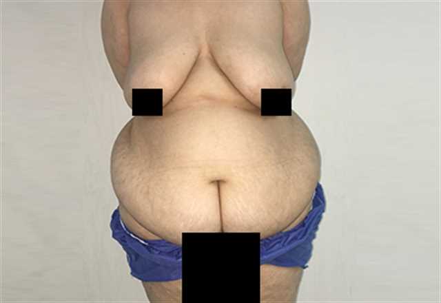 Tummy Tuck