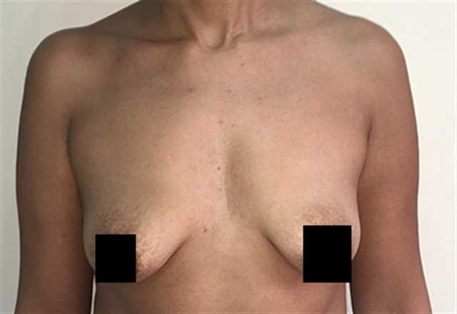 Breast Augmentation