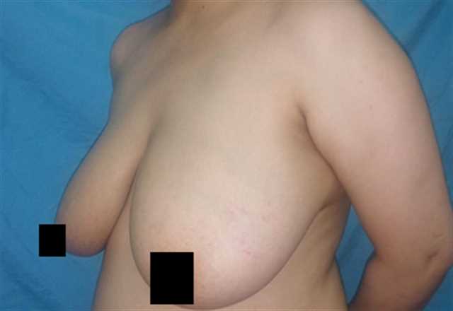 Breast Reduction