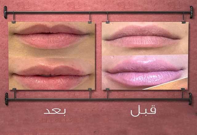 تجميل الوجه مع Lip Filler